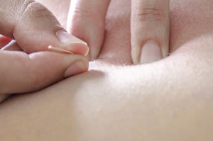 Manuelle Medizin Dry Needling Dry Needling